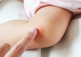 Atopik Dermatit Tedavi Edilmezse Hangi Sorunlara Yol Açar?