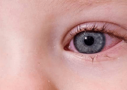 Çocuklarda Alerjik Konjonktivit Nedir