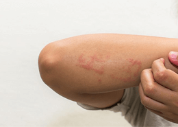 Yetişkinlerde alerjik egzama (atopik dermatit) nedir?
