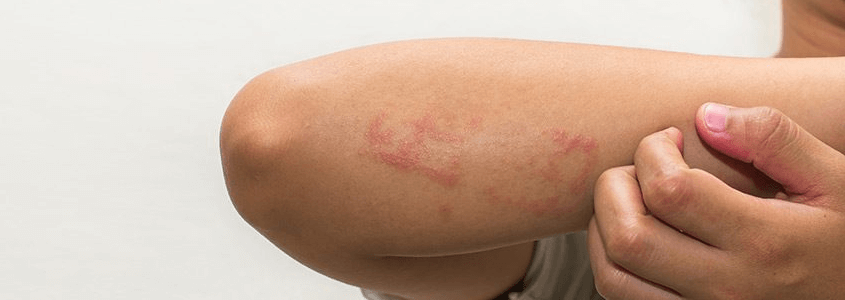 Egzama, oldukça yaygın ve çok sayıda kişiyi etkileyen bir cilt rahatsızlığıdır. Özellikle çocuklarda görülen ve bazı