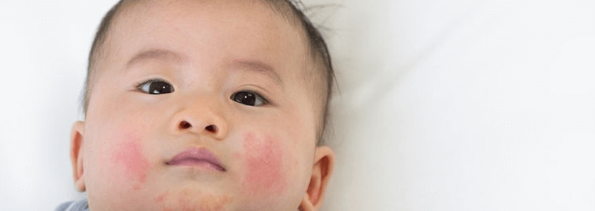 Egzama nedir Egzama neden olur Egzama belirtileri nelerdir