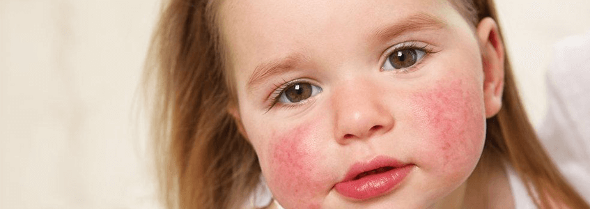Çocuklarda besin alerjisi neden olur