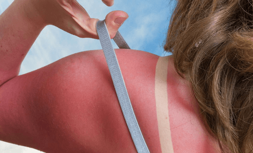 Güneş alerjisi nedir Güneş alerjisi belirtileri ve tedavisi