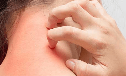 Isı artışı ürtikerinin belirtileri nelerdir?