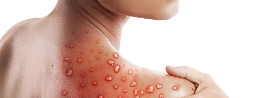 Maymun Çiçeği Virüsü